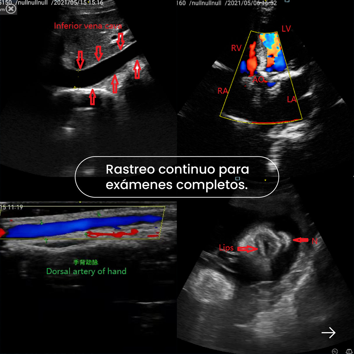 Ultrasonido Portátil INTEGRA II